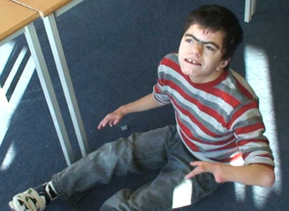 Mild Cornelia De Lange Syndrome